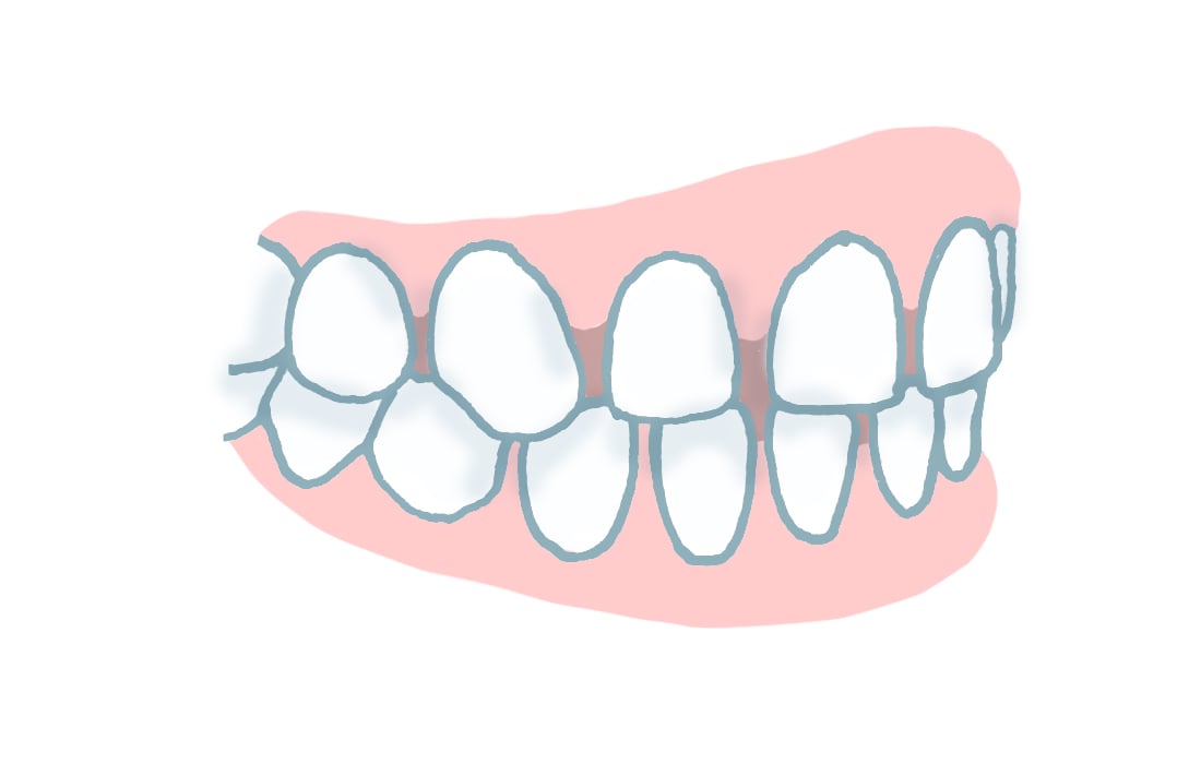 Zahnfehlstellung Zahnlücken